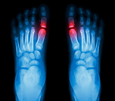 “Rheumatoid arthritis , Gouty arthritis” X-ray child’s foots and arthritis at metatarsophalangeal joint (Big toe area)