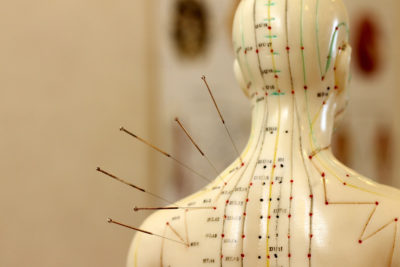Viele Schmerzpatienten versuchen auch Akupunktur als Behandlung. Im EBM sind die Indikationen dafür aber begrenzt. Doch auch bei Selbstzahlern nach GOÄ empfiehlt es sich oft, einen Behandlungsvertrag abzuschließen.