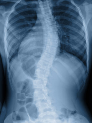 Die Verlaufskontrolle mit Videoraster-Bild hat zur Diagnose gegenüber Röntgen einige Nachteile. Nach Einschätzung des IQWiG hat sie aber dennoch ihren Platz im Behandlungsspektrum. 
