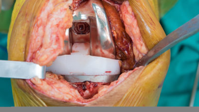 arthroplasty of knee
