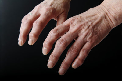Nur die rechtzeitige Behandlung, ggf. mit DMARDs (Disease Modifying Antirheumatic Drugs), kann die Gelenkzerstörung bei Rheumatoider Arthritis (RA) aufhalten. Dieser zweiteilige Beitrag gibt einen Leitfaden zur Abklärung schmerzhafter Gelenke an die Hand. Der Schwerpunkt liegt dabei auf der Früherkennung der RA.
